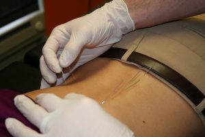 Low Back Picture with Acupuncture