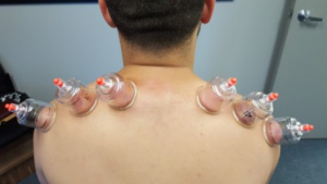 Cupping of the Shoulders