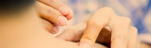 Needling Picture